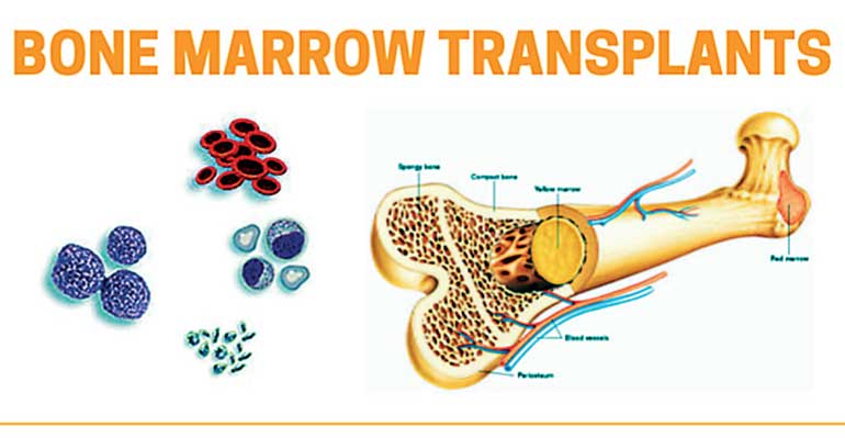 nawaloka-hospital-completes-30-successful-bone-marrow-transplants